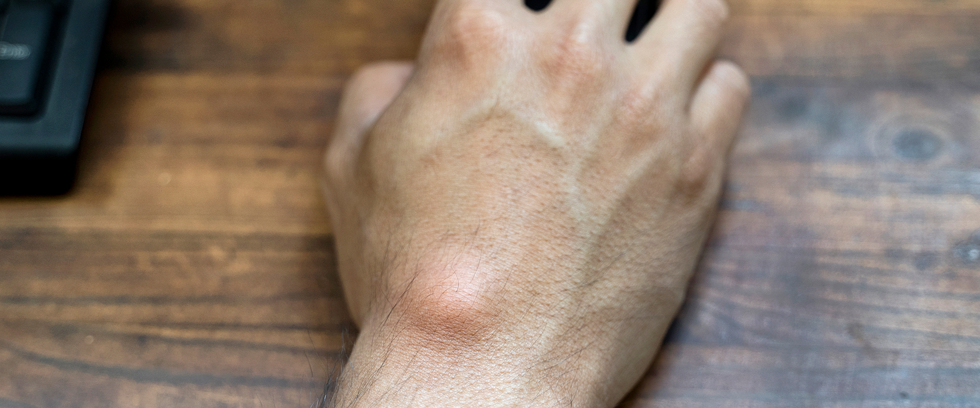 Hand mit einem Ganglion bedient eine Computermaus