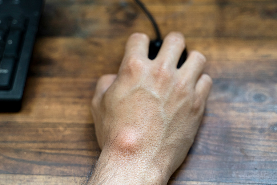 Hand mit einem Ganglion bedient eine Computermaus